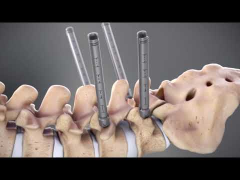 DepuySynthes: Viper Prime