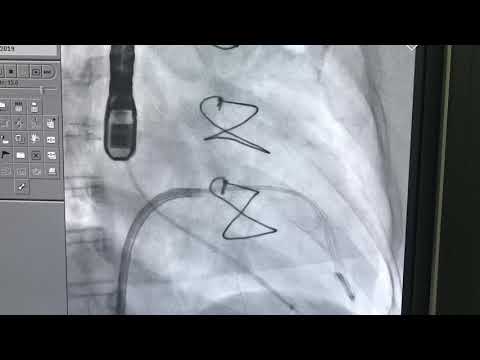 TMVR . Valve in Valve