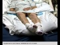 Shivering in Comatose Patients Part 1