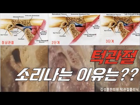 수술 없이 턱관절 치료하는 법
