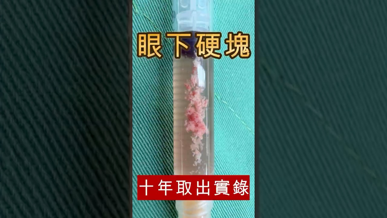 眼下舒顏萃結塊取出