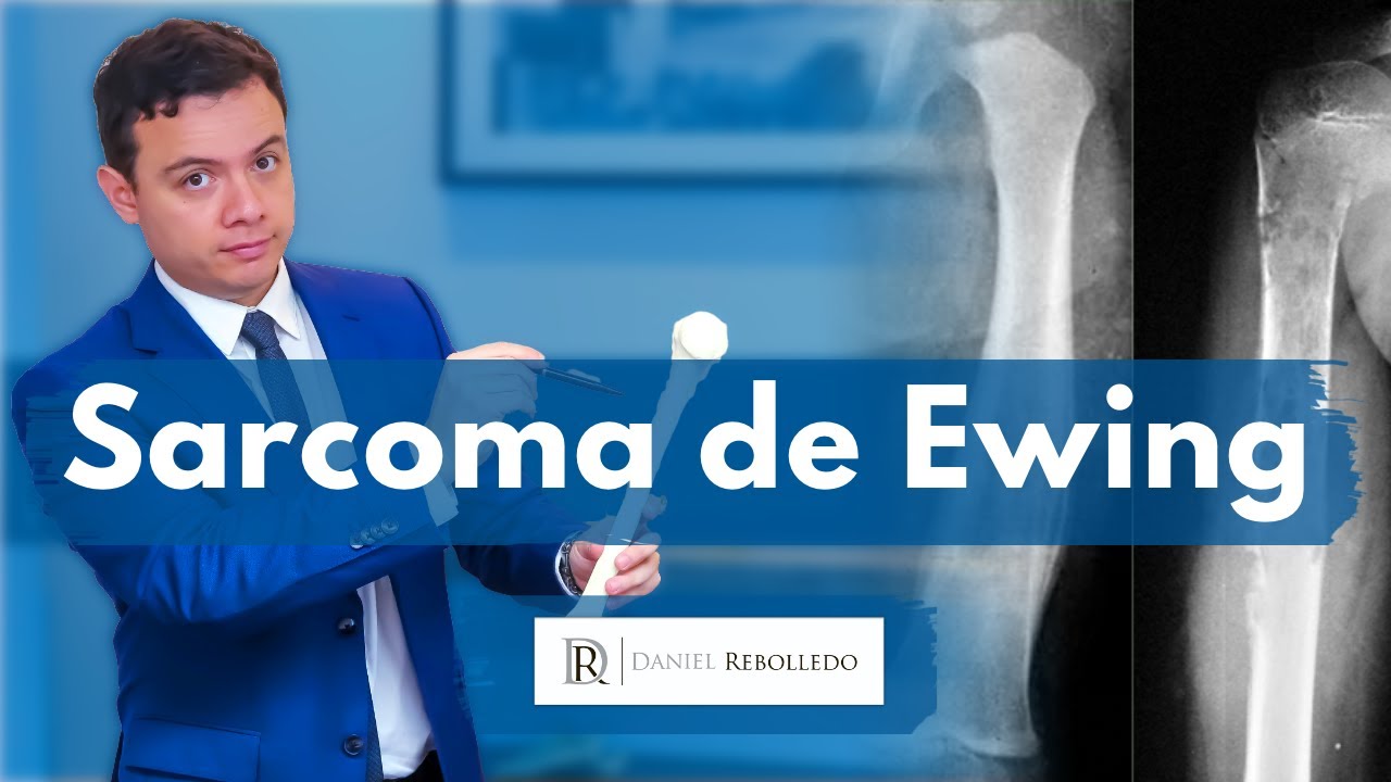 Sarcoma de Ewing