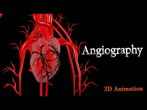 Angiographie – Vollständige visuelle Anleitung (3D-Animation)