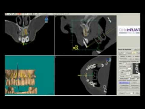 Bohrschablone Dentallabor Wentzsche