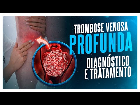 TROMBOSE VENOSA PROFUNDA - DIAGNÓSTICO  E TRATAMENTO