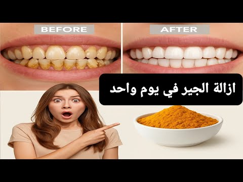 The recipe that dentists are hiding from us🔥!It whitens teeth and eliminates tartar in 1 minutes