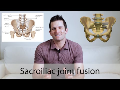 Sacroiliac joint fusion surgery