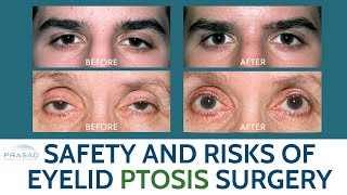 Ptosis Surgery Risks and Safety - What You Need to Know