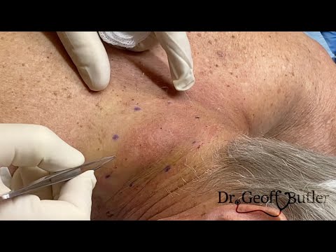 Removal of a lipoma at the base of the neck