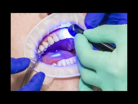 Ein neues Lächeln dank Veneers!