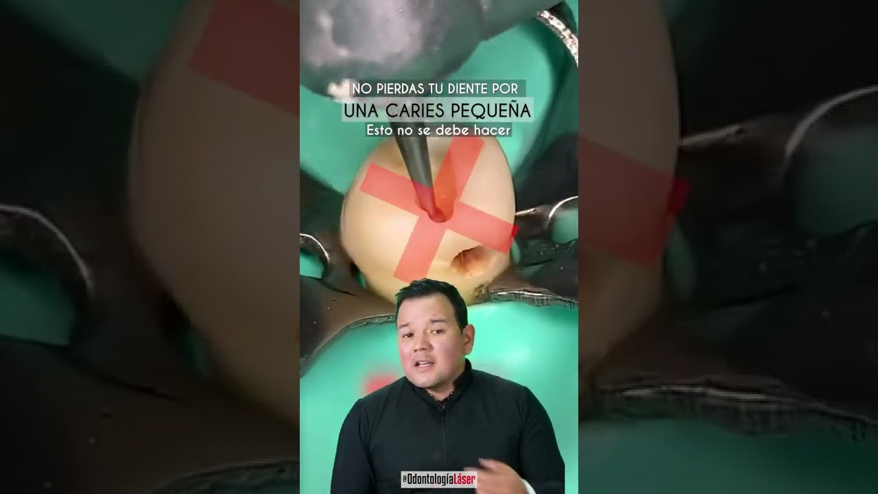 ¿Se debe quitar mucho diente para retirar una Caries ¿Mejor con Láser - Odontología Láser #Shorts