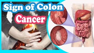 Signs And Symptoms of Colon Cancer You Should Not Ignore