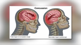 Understanding Concussions with NP Chris Jackman