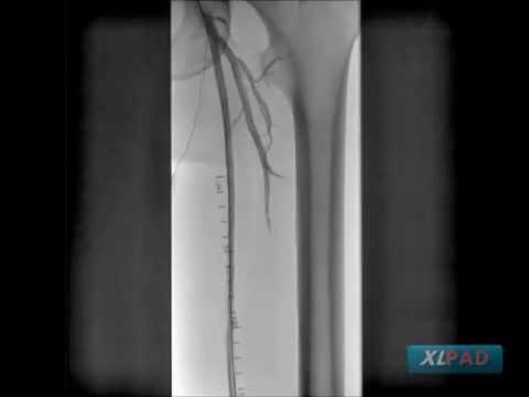 Proximal to Distal SFA CTO Treated with Viance