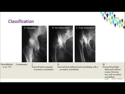 OrthoFracs - Adult Hip Dysplasia by Dr Karen Bourns