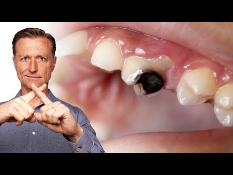 How to Never Get Another Cavity Ever Again