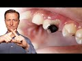 How To Never Get Another Cavity Ever Again