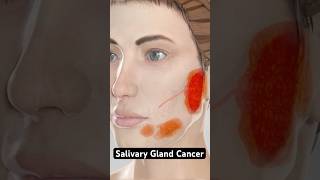 Download lagu Cancer in your salivary glands (3D Animation) mp3
