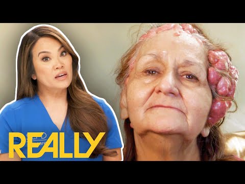 Dr Lee SHOCKED By Worst Case Of Cylindromas She's Ever Seen! | Dr Pimple Popper