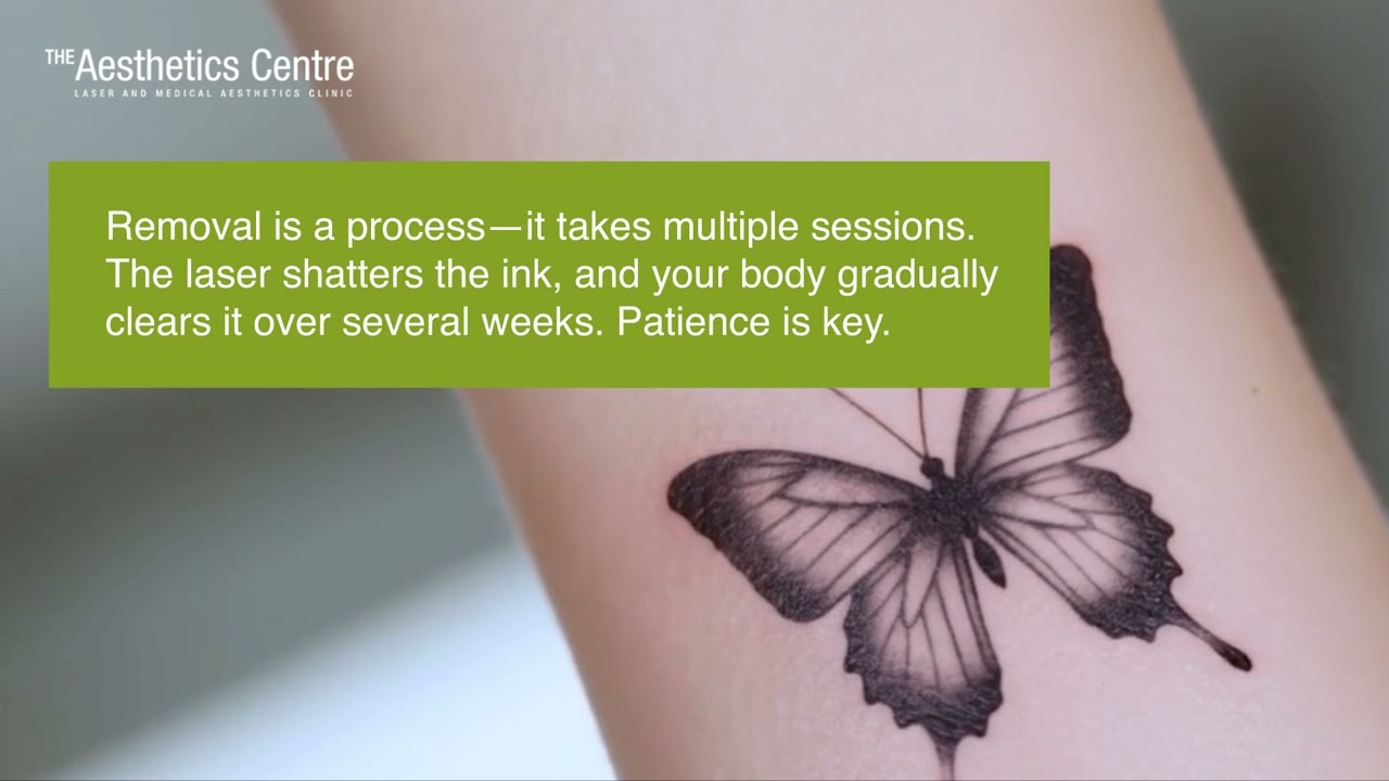 Things To Expect For Laser Tattoo Removal | The Aesthetics Centre