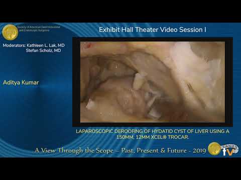 Laparoscopic Deroofing Of Hydatid Cyst Of Liver Using A 150mm, 12mm Xcel® Trocar