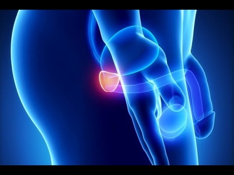 Tensione prostata permanente Trattamento della prostata in Francia