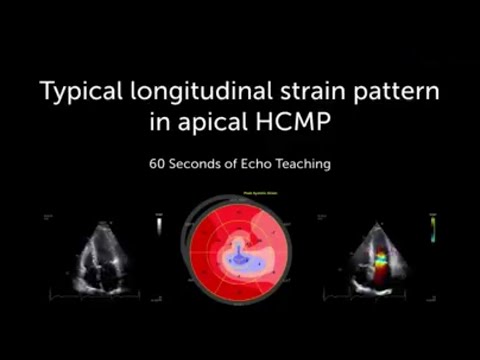 Typical Longitudinal strain in Apical HCMP
