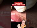 Crazy Painful BLACKHEAD REMOVAL AROUND LIPS - Super Satisfying #shorts