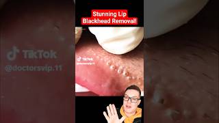 Crazy Painful BLACKHEAD REMOVAL AROUND LIPS - Super Satisfying #shorts