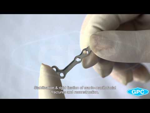 Titanium mini l - plate for 2.0mm screws