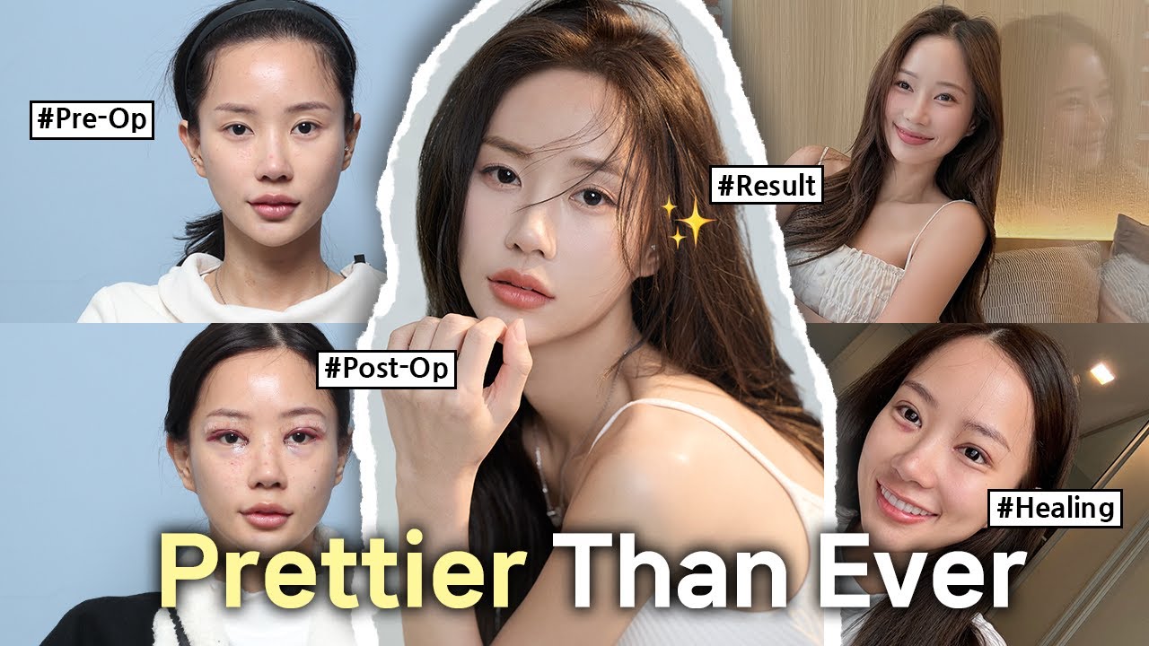Surgery that makes eyes look naturally balanced NANA Korea YouTube video