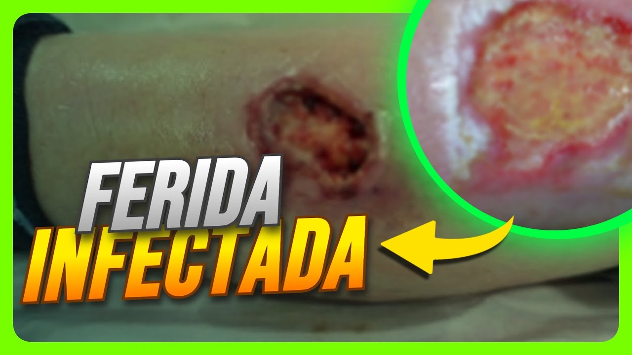 FERIDA INFECTADA: COMO TRATAR UMA FERIDA COM INFECÇÃO?