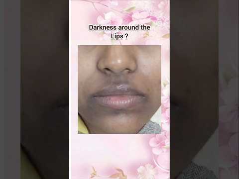 Solution of Darkness Around Mouth!How to remove dark patches on skin #fyp #shorts #shortfeed #kpop