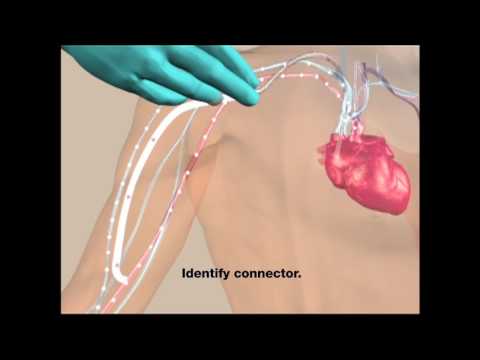 HeRO® Graft - Overview of Implant & Cannulation Animation