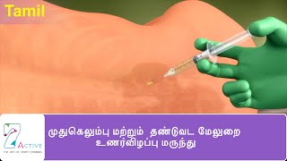 SPINAL & EPIDURAL ANAESTHESIA | Tamil