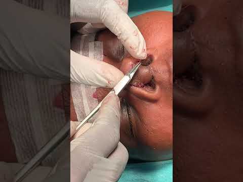 Reconstructive Rhinoplasty