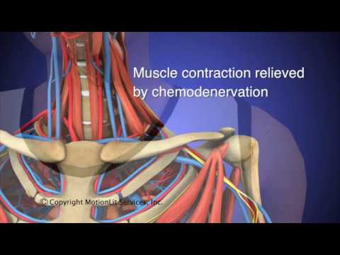 Thoracic Outlet Syndrome (TOS) Animation HD