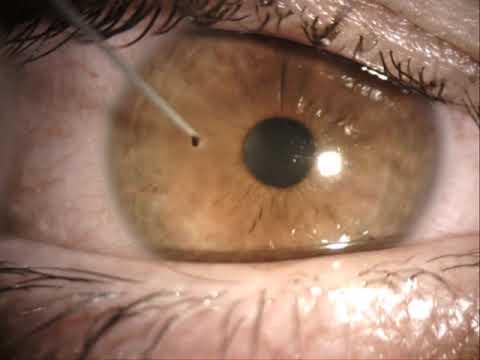 corneal foreign body removal like a boss