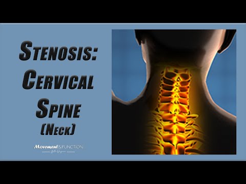 Cervical Spine Stenosis | Best Exercises to Decrease Pain (and Other Symptoms)