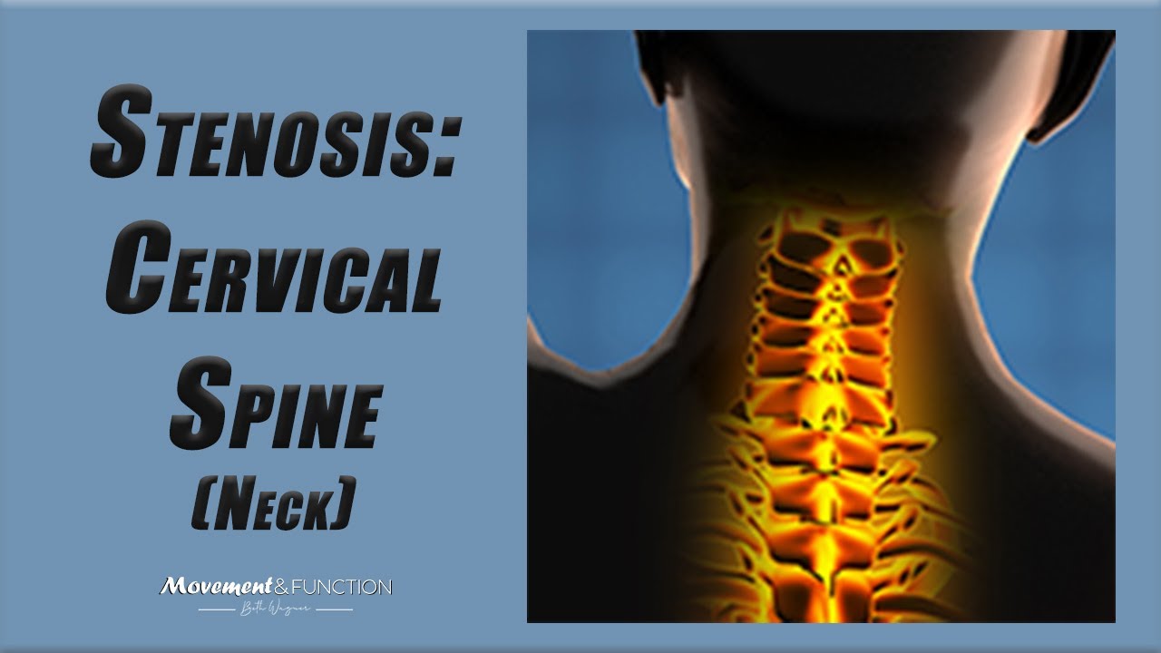 Cervical Spine Stenosis | Best Exercises to Decrease Pain (and Other Symptoms)