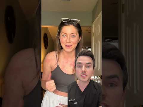 Random Hives (& swelling) that come and go #hives #skinrashes #itchyskin #dermatologist