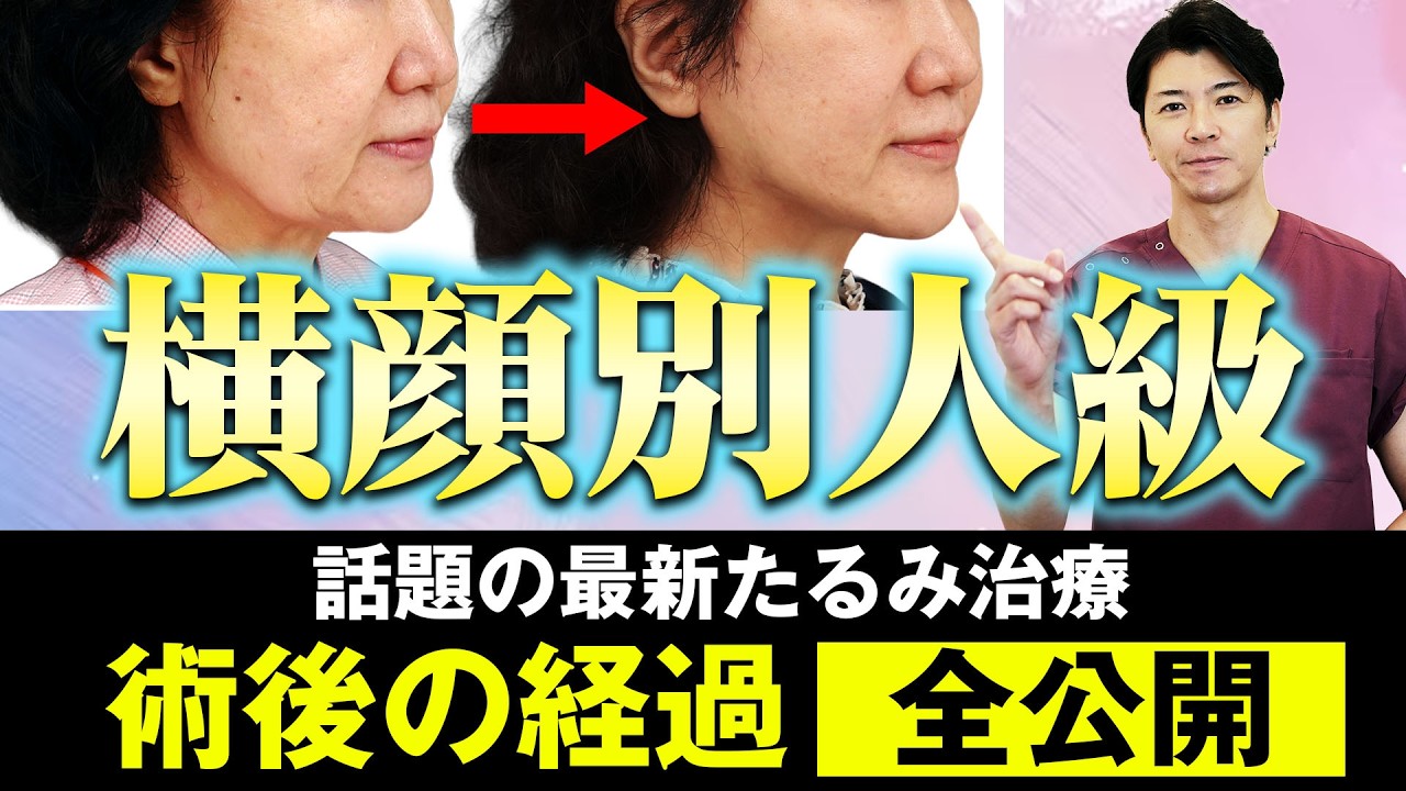 【症例解説】老け見えの原因「たるみ」を解消して横顔美人になる方法