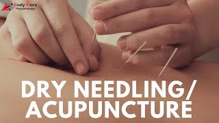 preview picture of video 'Dry Needling/Acupuncture by Physio's-by Jason Bradley (BodyWorx Physio Newcastle)'