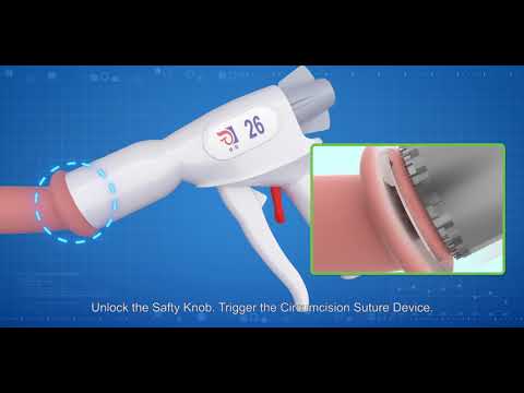 LangHe Medical - CircCurer - Disposable Circumcision Suture Device - 2nd generation-Demo