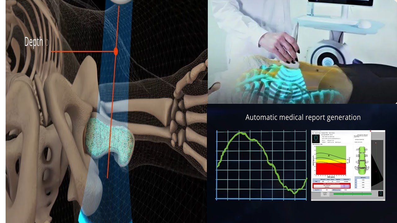 EchoLight Bone Densitometry