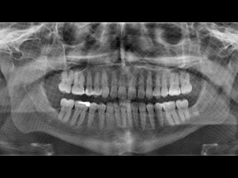 Video thumbnail for Vertebreaker