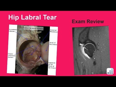 Hip Labral Tear Exam Review - John Clohisy, MD