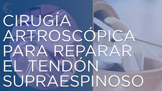 Me he roto el tendón supraespinoso del hombro | Cirugía para reparar el tendón del hombro