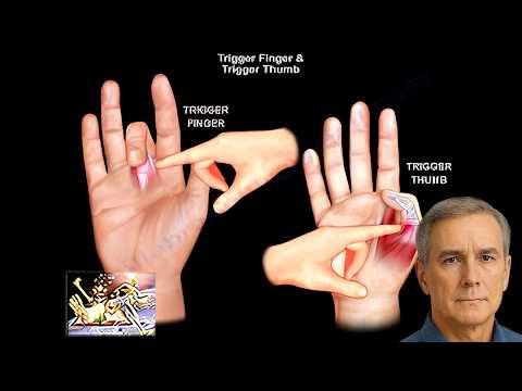 The 3 ways Sjögren’s Syndrome can Actually affect your hands - a Rheumatologist explains