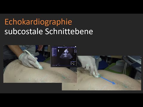 subcostale Schnittebene - Echokardiographie